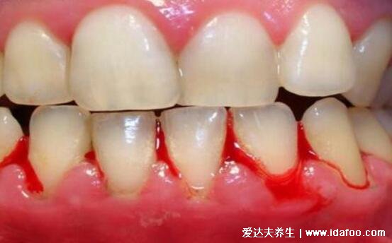 早期牙龈炎图片症状及治疗方法，牙龈出血的时候需警惕(5大症状)