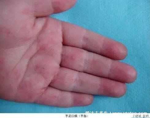 手足口病刚开始的图片，身上长轻微小红点是初期症状(不容小觑)