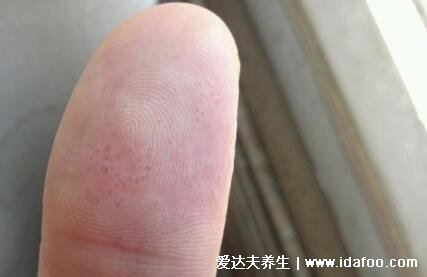 汗疱疹初期图片及症状，手足上对称分布的小水泡需要警惕