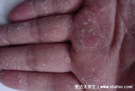 汗疱疹初期图片及症状，手足上对称分布的小水泡需要警惕
