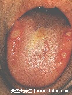 口腔疱疹图片初期症状，口腔出现水泡是发病前兆(注意口腔卫生)