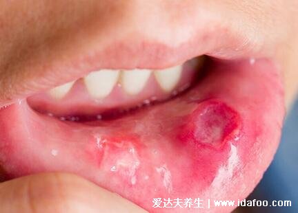 口腔疱疹图片初期症状，口腔出现水泡是发病前兆(注意口腔卫生)