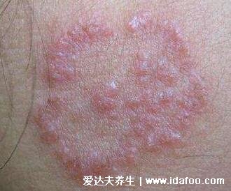 皮炎和湿疹的区别图片，一招辨别是湿疹还是皮炎