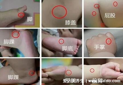 最真实的小儿手足口病症状图片，身上起许多水泡的孩子需要注意