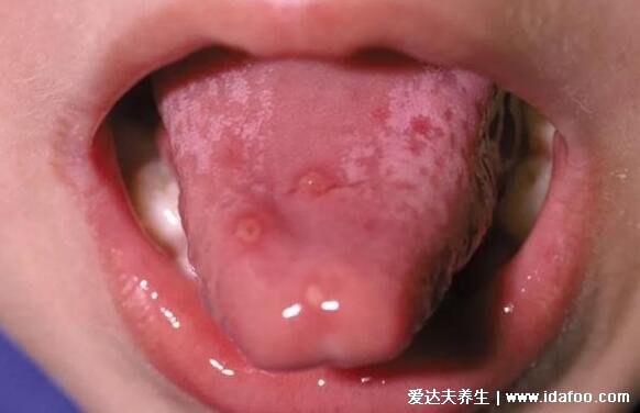 口腔粘膜丘疹图片，常见的口腔溃疡/口腔炎/手足口病要学会区分