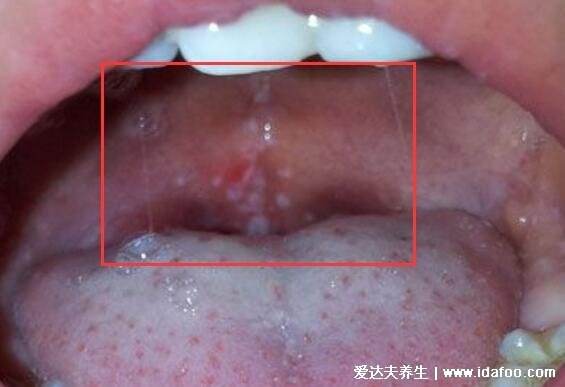 口腔粘膜丘疹图片，常见的口腔溃疡/口腔炎/手足口病要学会区分
