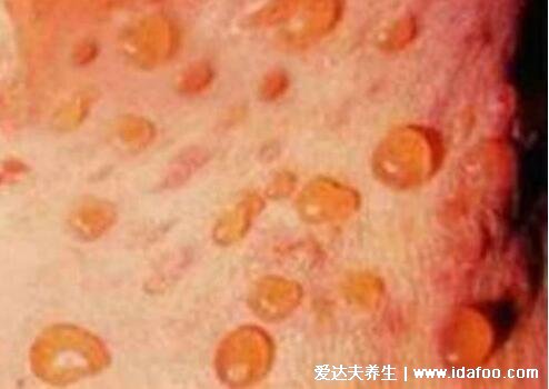 男性疱疹的症状图片大全，早期生殖器疱疹/带状疱疹图合集