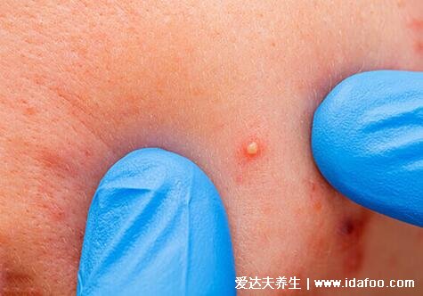 炎症丘疹型痘痘图片，不及时治疗会发展成脓包留疤