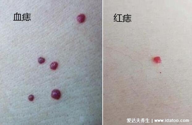 正常人身上小红点图片，这两种红点千万别大意可能是肝病前兆