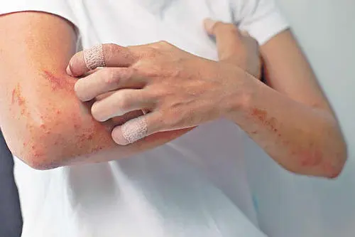湿疹是什么样子的图片，明显红斑和米粒大小丘疹(熬夜的悲哀)
