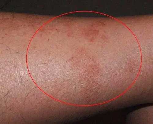 湿疹是什么样子的图片，明显红斑和米粒大小丘疹(熬夜的悲哀)