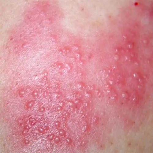 病毒性疱疹的症状图片，有成片红的水疱（带状疱疹会刺激神经）