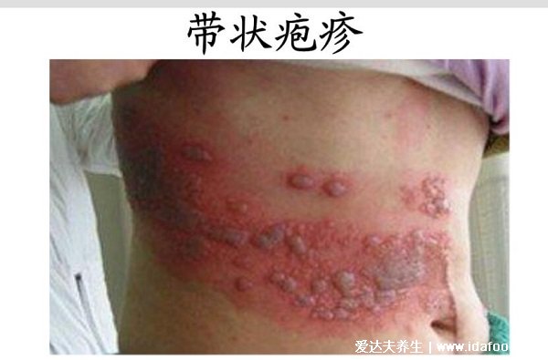 病毒性疱疹的症状图片，有成片红的水疱（带状疱疹会刺激神经）