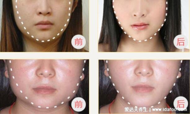 适合打瘦脸针的脸型图片，从U型脸到V字精致小脸(瘦脸针一之10天效果图) 