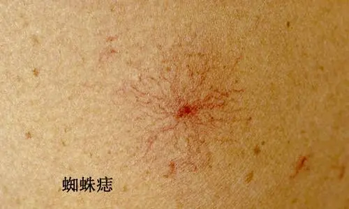 皮肤上有小红血点图片，可能是过敏/蜘蛛痣（小心肝有问题）