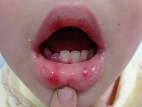 单纯疱疹图片，接吻最容易传染(嘴唇处最常见)