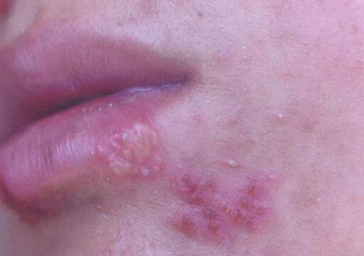 单纯疱疹图片，接吻最容易传染(嘴唇处最常见)