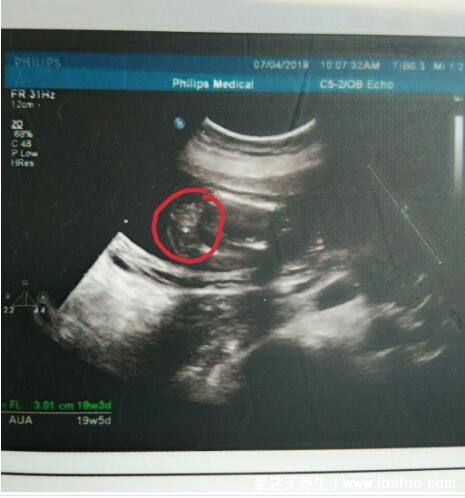 什么提示你怀了男宝宝，看B超孕囊形状（长条状可能是男宝宝）