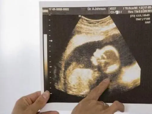 什么提示你怀了男宝宝，看B超孕囊形状（长条状可能是男宝宝）