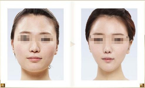 打完瘦脸针的图片效果对比，三个月脸型变化明显（附瘦脸针自测法）