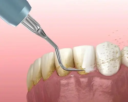 洗牙对牙齿有害吗?会损伤牙齿么？可能有牙齿划痕（但危害小）
