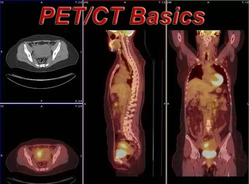pet-ct是什么检查，可以用于早期肿瘤检查