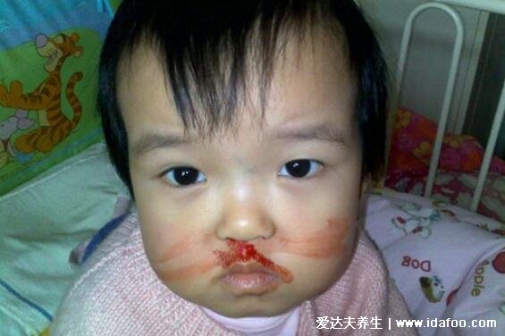 儿童白血症前兆图片及症状，容易鼻出血全身长突起的小红点
