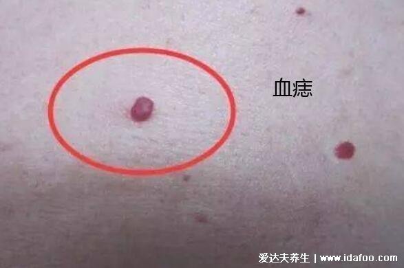 肝癌身上出现红点图片，血痣/蜘蛛痣可能是严重肝病的前兆