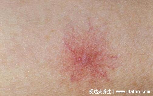 肝癌身上出现红点图片，血痣/蜘蛛痣可能是严重肝病的前兆