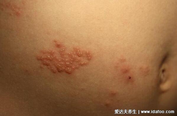 女性疱疹病毒的症状图片，单纯疱疹/带状疱疹/生殖器疱疹/汗疱性湿疹合集