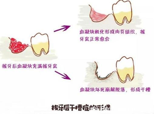 干槽症早期症状图片，拔牙后3-5天痛感加剧牙洞成暗灰色有异味
