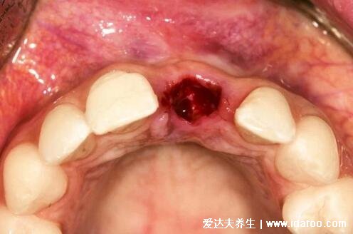 干槽症早期症状图片，拔牙后3-5天痛感加剧牙洞成暗灰色有异味