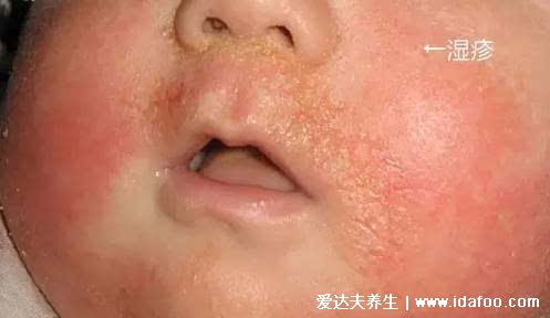 热痱子和湿疹的区别图，热痱子是一粒粒的（湿疹消散不快）