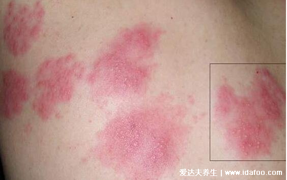 白血病早期出血点图片，多为紫红色针尖样小红点(7大典型症状)