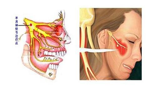人体三叉神经痛是哪个部位图解，牙齿和鼻翼可能疼(女性更易得)