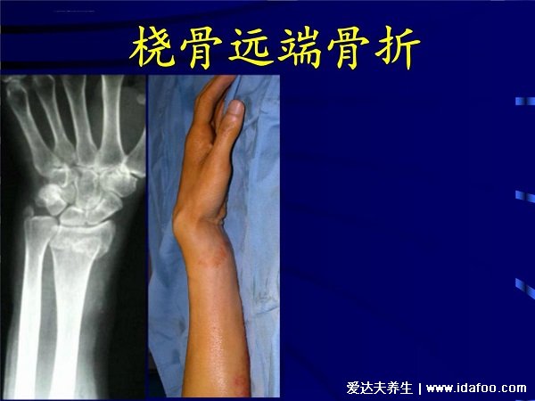 人体桡骨是哪个部位图片图解，前手臂骨大拇指一侧(儿童易骨折)