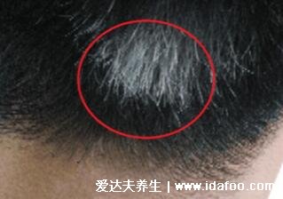 三个部位长白发最危险，脑门/后颈/后脑(早了解早预防)