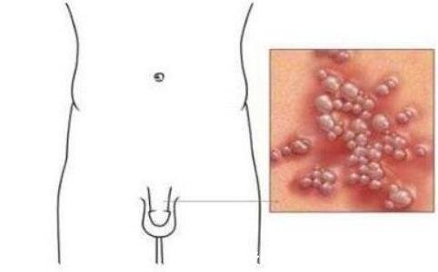 水泡和疱疹的区别图片，水泡无害疱疹有害(水泡型疱疹介绍)