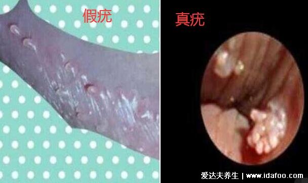 淡红色的珍珠状丘疹1,假性湿疣女性假疣和真疣的图片