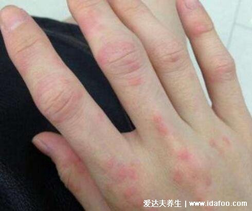 常见湿疹分为五种类型图片，都有剧烈的瘙痒感还易反复发作
