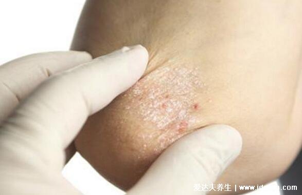 常见湿疹分为五种类型图片，都有剧烈的瘙痒感还易反复发作