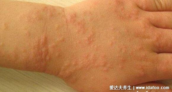 18种常见的皮肤病图片及症状，牛皮癣/荨麻疹/湿疹/皮疹对照合集