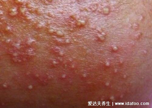 热痱子的症状图片，湿疹和热疹的区别图片