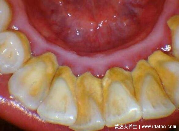 牙结石图片可以自己抠掉吗，牙齿表面是黄色黑色（不可以抠掉）