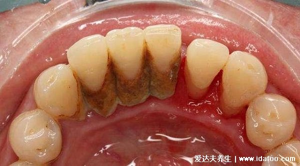 牙结石图片可以自己抠掉吗，牙齿表面是黄色黑色（不可以抠掉）