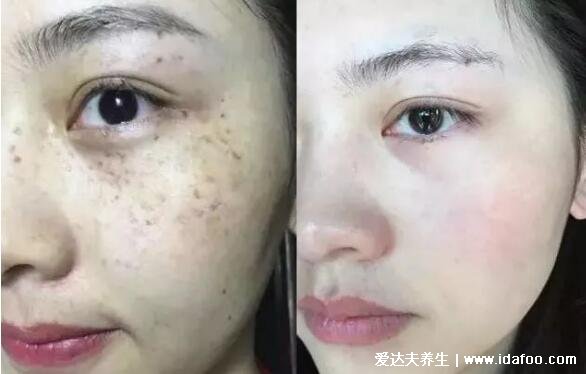 皮肤改善前后对比照片，5组图告诉你美容护肤的重要性