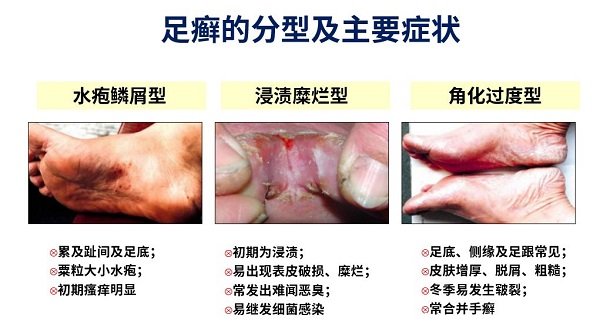 足癣初期症状及图片，水疱型会很痒还有小水疱(附3种类型足藓)