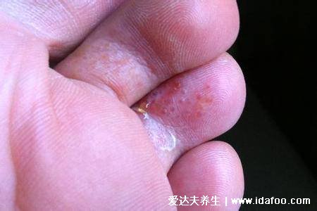 足癣初期症状及图片，水疱型会很痒还有小水疱(附3种类型足藓)