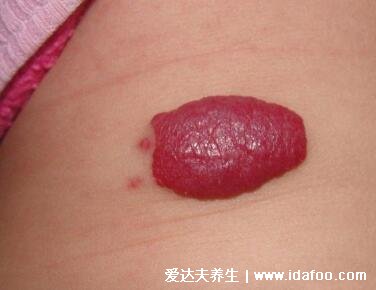 血管瘤长什么样子图片，皮肤上的红色小肿瘤(常见于婴儿身上)