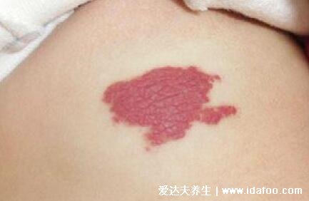 血管瘤长什么样子图片，皮肤上的红色小肿瘤(常见于婴儿身上)